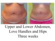 MyShape Lipo Announces Innovative New Tumescent Liposuction Training...